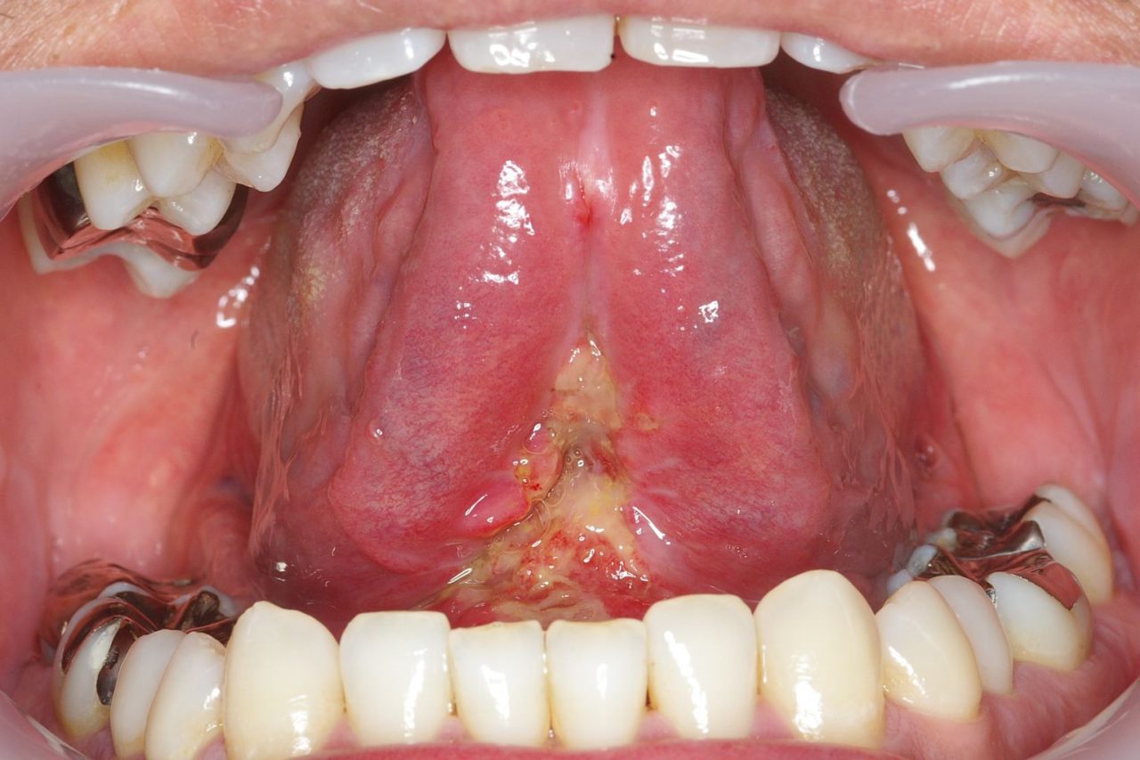 大人の舌小帯短小症 豊中市の歯医者 うおた歯科医院